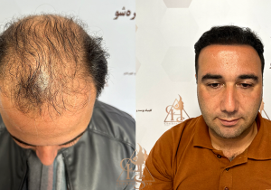 کاشت مو؛ بررسی روش‌های جراحی و غیرجراحی