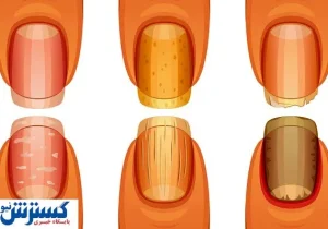 تشخیص سرطان ریه از روی ناخن ممکن شد